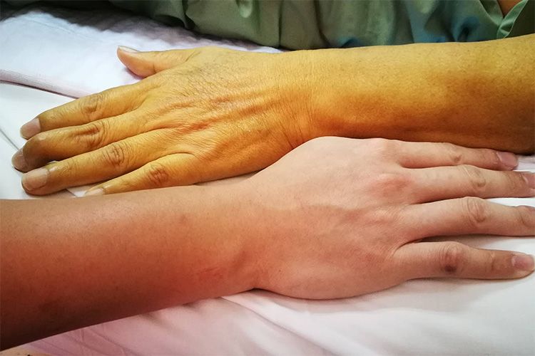 VÀNG DA – DẤU HIỆU KINH ĐIỂN NHẤT CỦA SUY GIẢM CHỨC NĂNG GAN