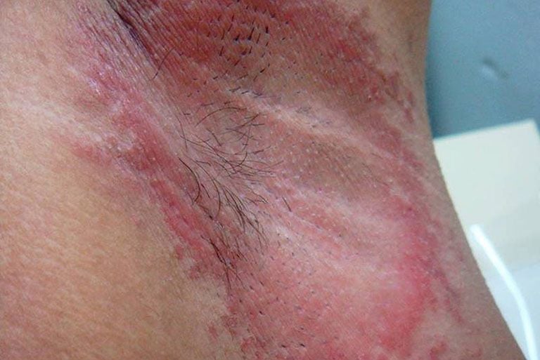 NẤM NÁCH – CĂN BỆNH “KHÓ NÓI” NHIỀU NGƯỜI MẮC