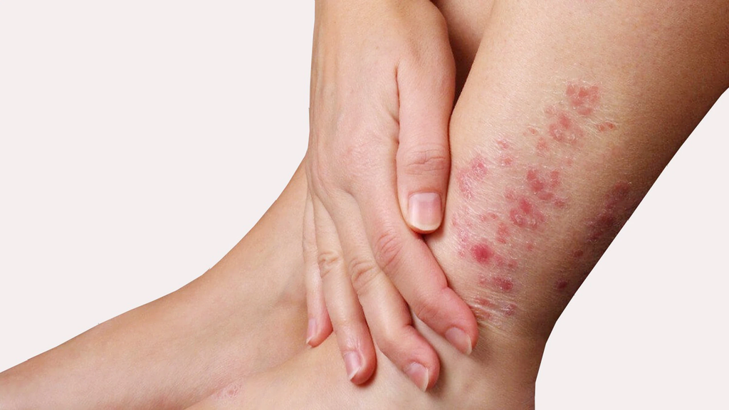 Cảm giác “bò dưới da”, “châm chích”, “nóng rát” thường bị nhầm với bệnh ngoài da như nấm da