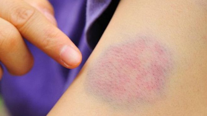 XUẤT HIỆN BẦM TÍM DỄ DÀNG HOẶC CHẤM XUẤT HUYẾT LÀ DẤU HIỆU BỆNH GAN
