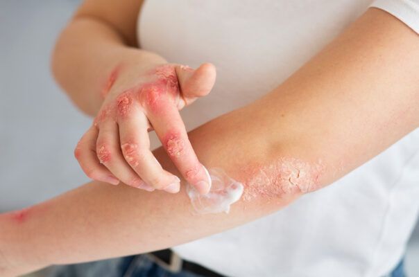 Người sử dụng kháng sinh hoặc thuốc ức chế miễn dịch lâu ngày