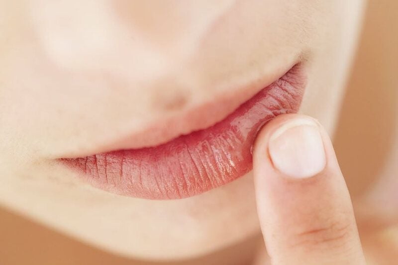 mụn nước ở môi nhiều người lầm tưởng là nhiệt miệng