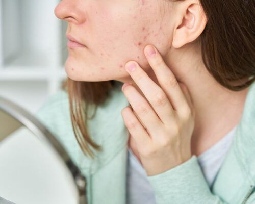 Vậy mụn và hormone có liên quan gì đến nhau?
