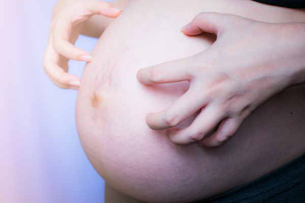 Vết rạn da (stretch marks) là một hiện tượng da thay đổi khi mang thai rất phổ biến