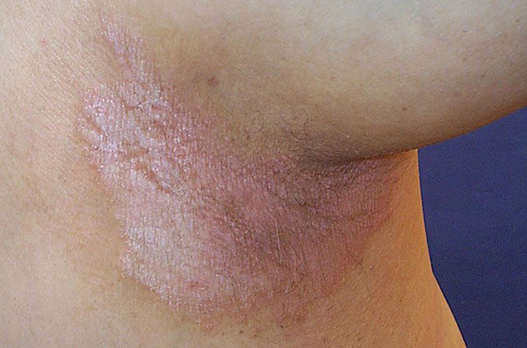 BỆNH VẢY NẾN ĐẢO NGƯỢC