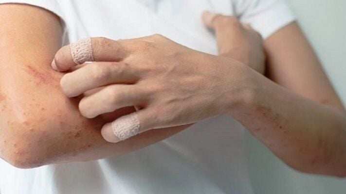 Cách giảm chàm tại nhà