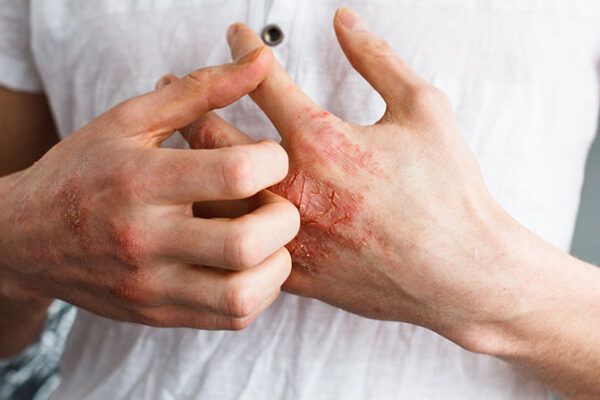 chàm hay viêm da cơ địa