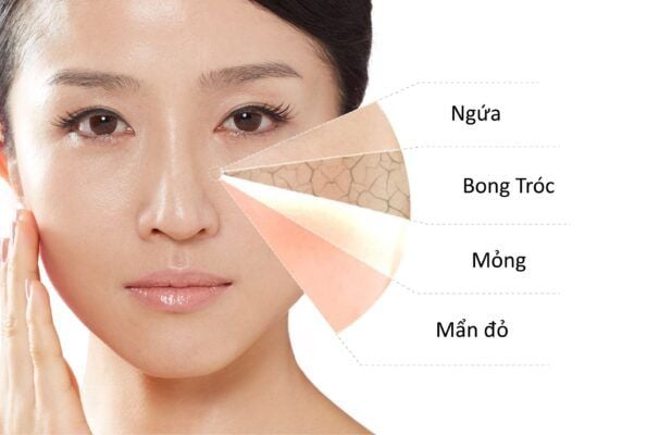 Da khô là làn da như thế nào?