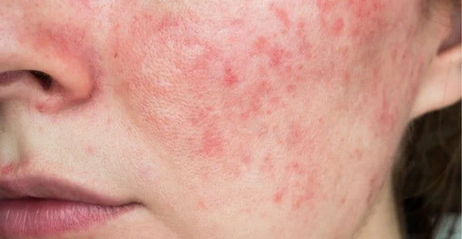 da nhiễm corticoid