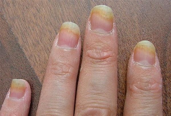 dấu hiệu nhận biết nấm móng