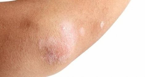dấu hiệu về da của bệnh tuyến giáp
