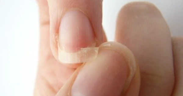 dấu hiệu về móng của bệnh tuyến giáp