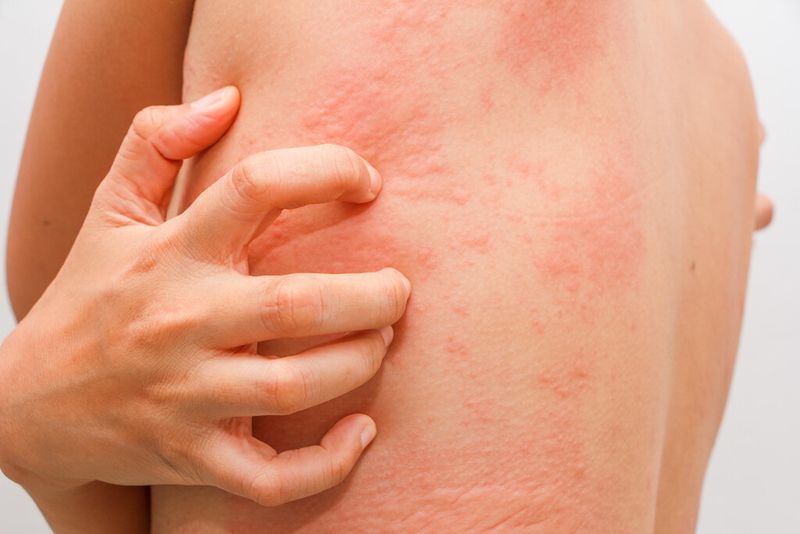 CÂU CHUYỆN- MẨN NGỨA CẢ NĂM KHÔNG HẾT, HÓA RA… BỆNH GAN