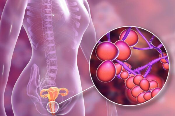 Điều trị như thế nào viêm phụ kho do nhiễm vi khuẩn