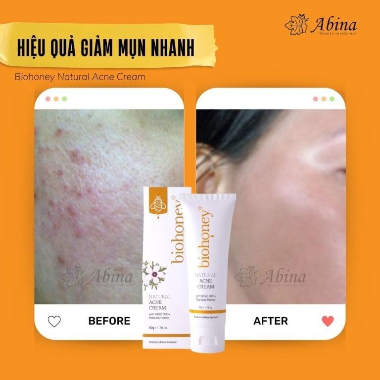 HIệu quả Kem mụn mật ong acne cream Biohoney