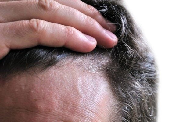 HIỂU ĐÚNG VỀ NẤM DA ĐẦU