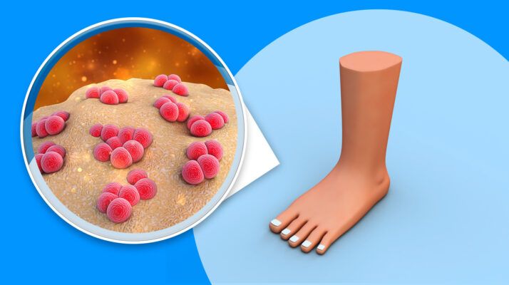 Nước ăn chân, còn gọi là nấm da chân, thường đi kèm với biểu hiện da bị đỏ hoặc ngứa quanh các kẽ ngón chân