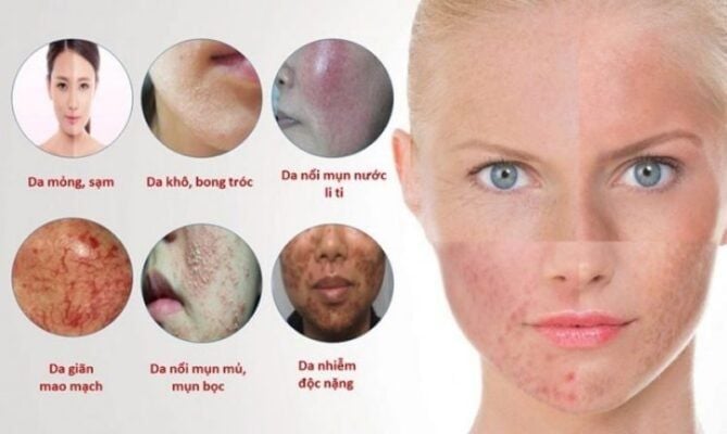 Biểu hiện của tình trạng da nhiễm corticoid