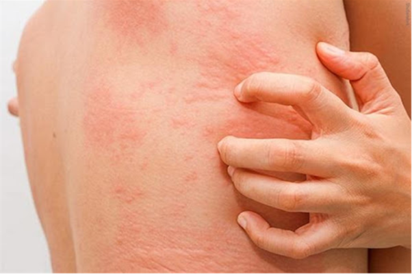 Hệ miễn dịch yếu sẽ thường mắc bệnh về da