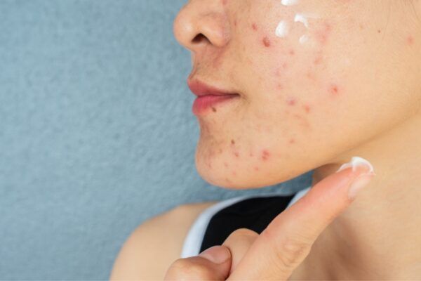 probiotic giúp giảm viêm, điều hoà tuyến bã nhờn giúp da đẹp lên