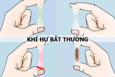 khí hư bất thường