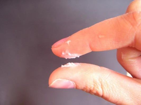 khí hư vón cục như bã đậu