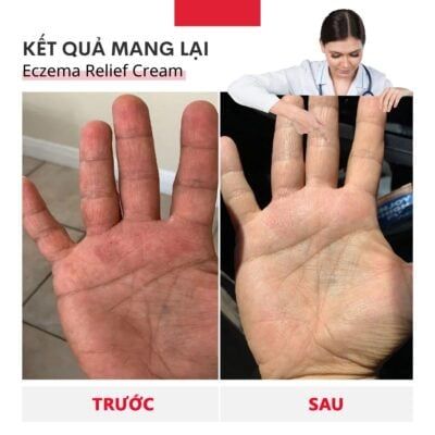 lavior eczema CHÀM DA 15ml (3)