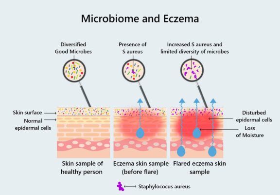 Ảnh hưởng của hệ vi sinh vật lên bệnh chàm và viêm da cơ địa Nguồn: Eczemaless