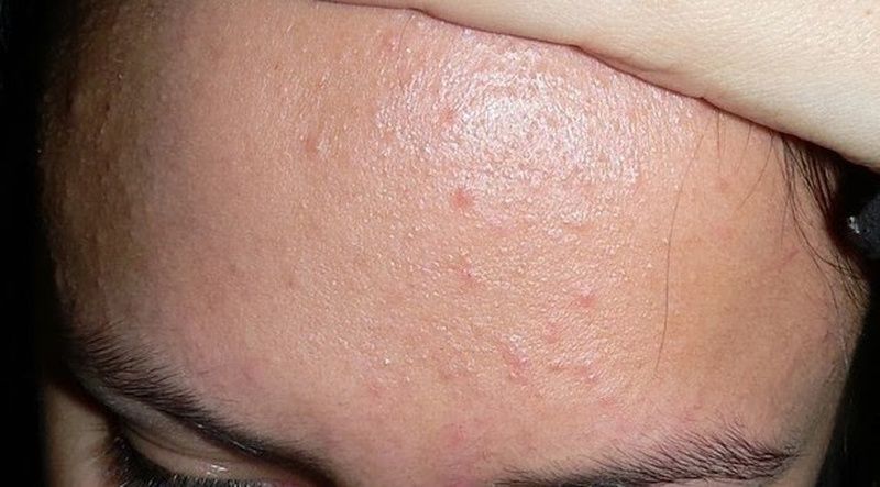 MÊ MAKEUP VÀ MẮC KẸT VỚI MỤN ẨN