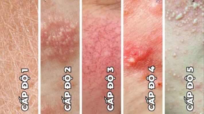 mức độ nhiễm corticoid