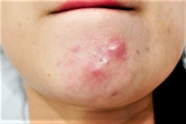 mụn viêm dưới cằm do RLNT