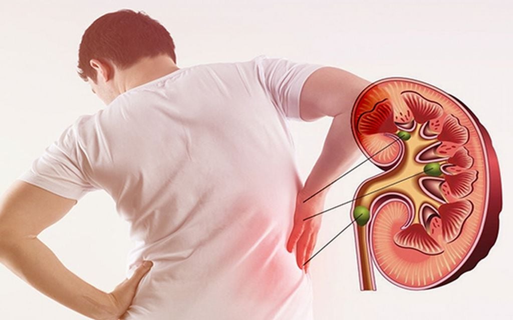 dùng canxi sai cách ở bệnh nhân ĐTĐ có thể tăng nguy cơ bị sỏi thận