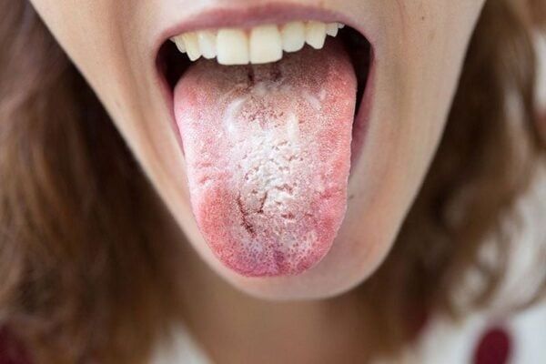nấm candida ở miệng lan rộng