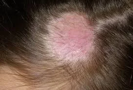 nấm da đầu gây rụng tóc