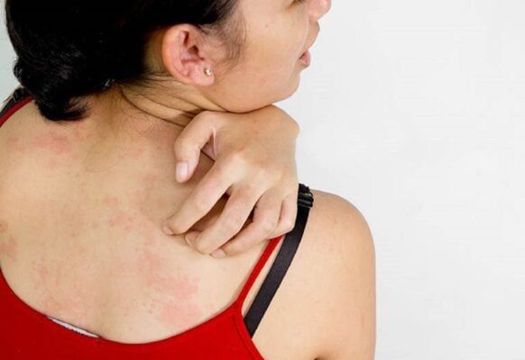 Nguyên nhân khiến da bị ngứa