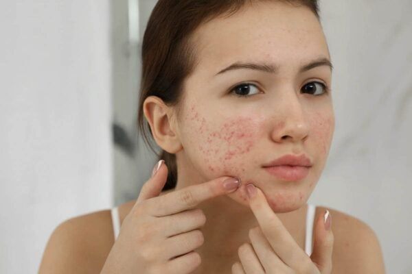 Nói lời chia tay với mụn