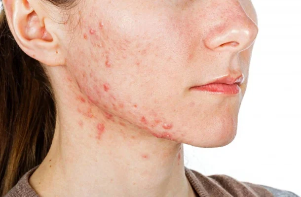 nội mụn viền hàm và đâu là lí do