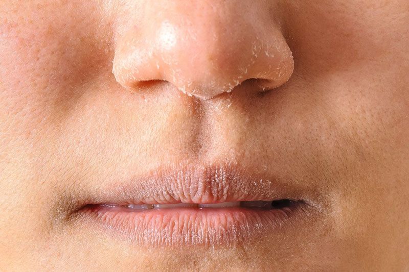 Da khô là gì? Cách phân biệt tình trạng da