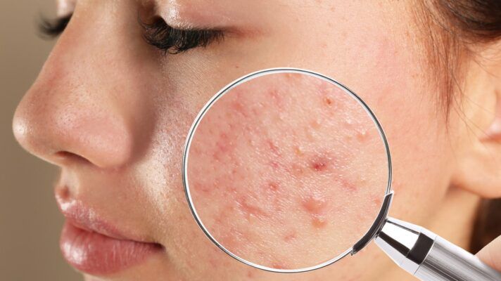 Rối loạn tiêu hóa tác động lên miễn dịch tạo ra mụn trứng cá