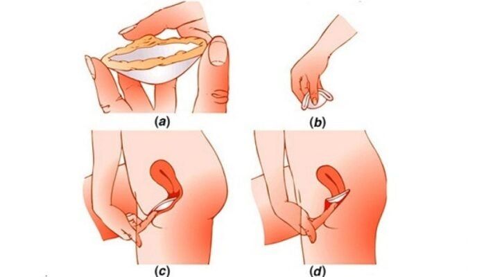 Tôi có nên thụt rửa nếu quan hệ tình dục mà không sử dụng biện pháp bảo vệ hoặc nếu bao cao su bị rách?