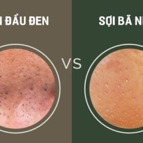 phân biệt sợi bã nhờn và mụn đầu đen