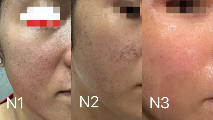 phản ứng của da sau laser