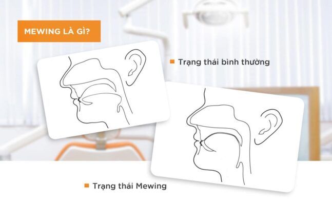 Phương pháp Mewing