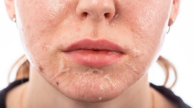 retinol gây bong da