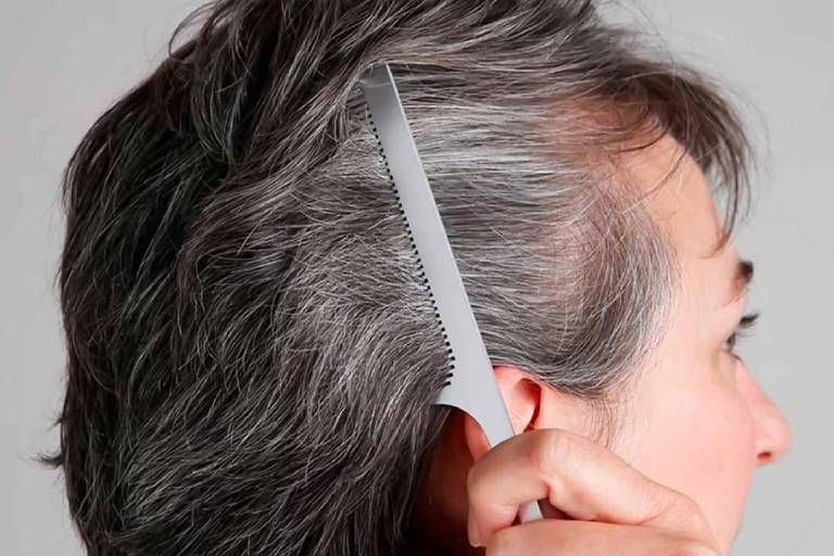 rụng tóc tuổi trung niên
