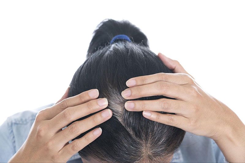 Rụng tóc từng mảng