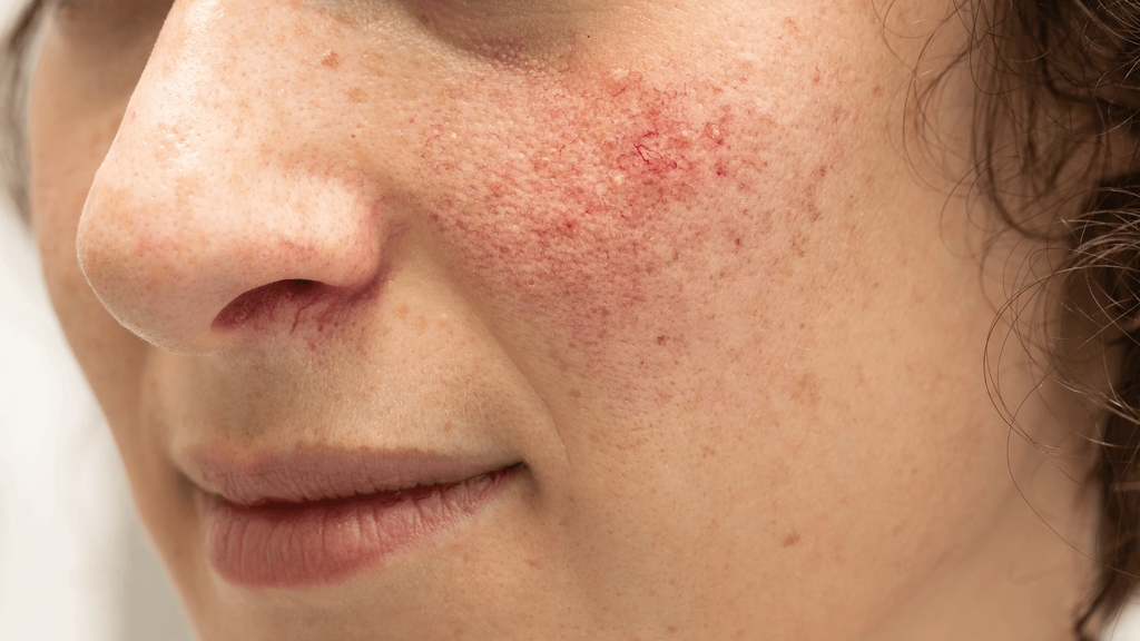 Erythematotelangiectatic Rosacea (ETR)