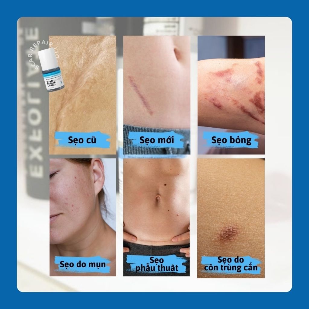 Gel Trị Sẹo Lồi Scarguard Repair Liquid 15ml