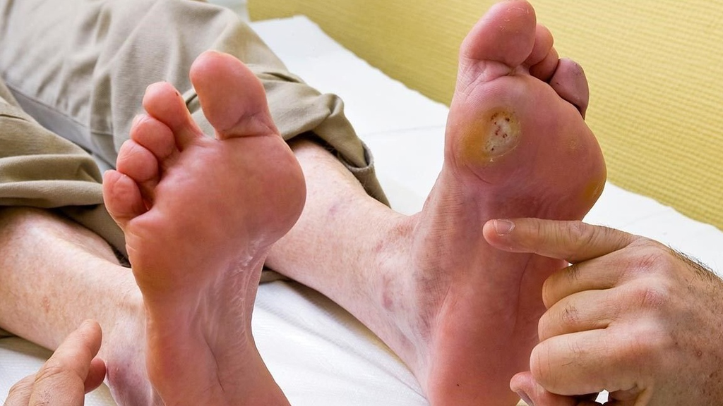 VÌ SAO LOÉT BÀN CHÂN GÂY ÁP LỰC TÂM LÝ?