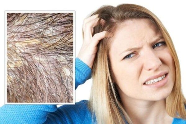 Tại sao trị mãi không hết nấm ngứa da đầu